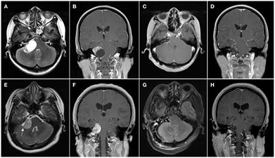 Nomogram for Predicting Facial Nerve Outcomes After Surgical Resection of Vestibular Schwannoma